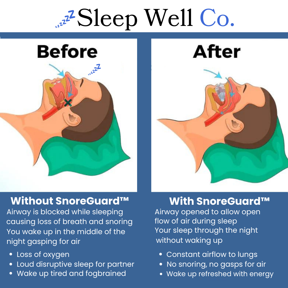 SnoreGuard™ for Sleep Apnea
